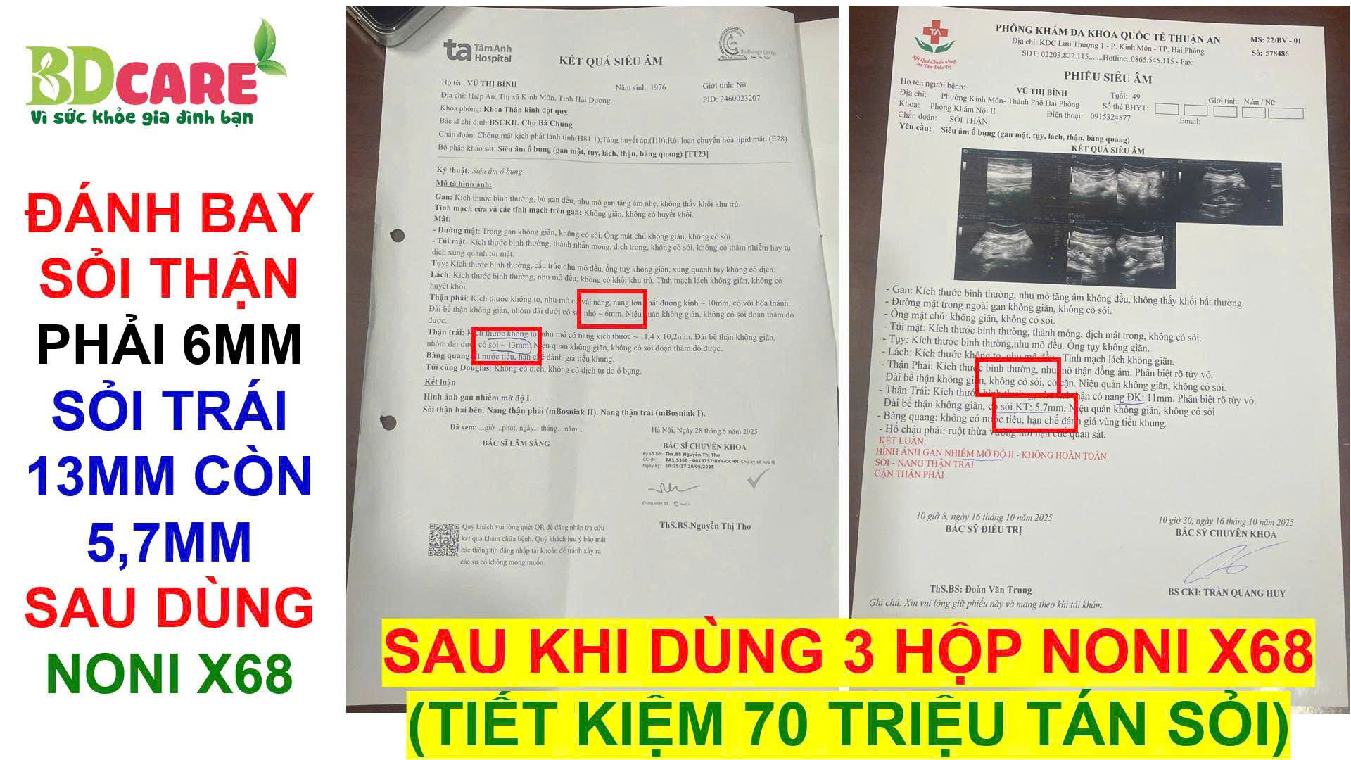 ĐÁNH BAY SỎI THẬN, SỎI TIẾT NIỆU CÙNG BDCARE