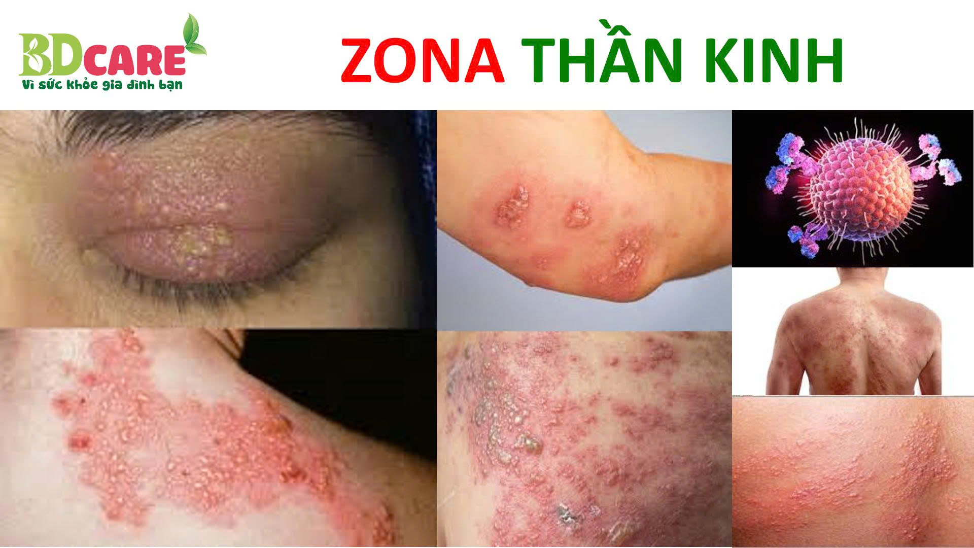 ZONA THẦN KINH KHÔNG CÒN ĐÁNG SỢ KHI BIẾT TỚI BDCARE!